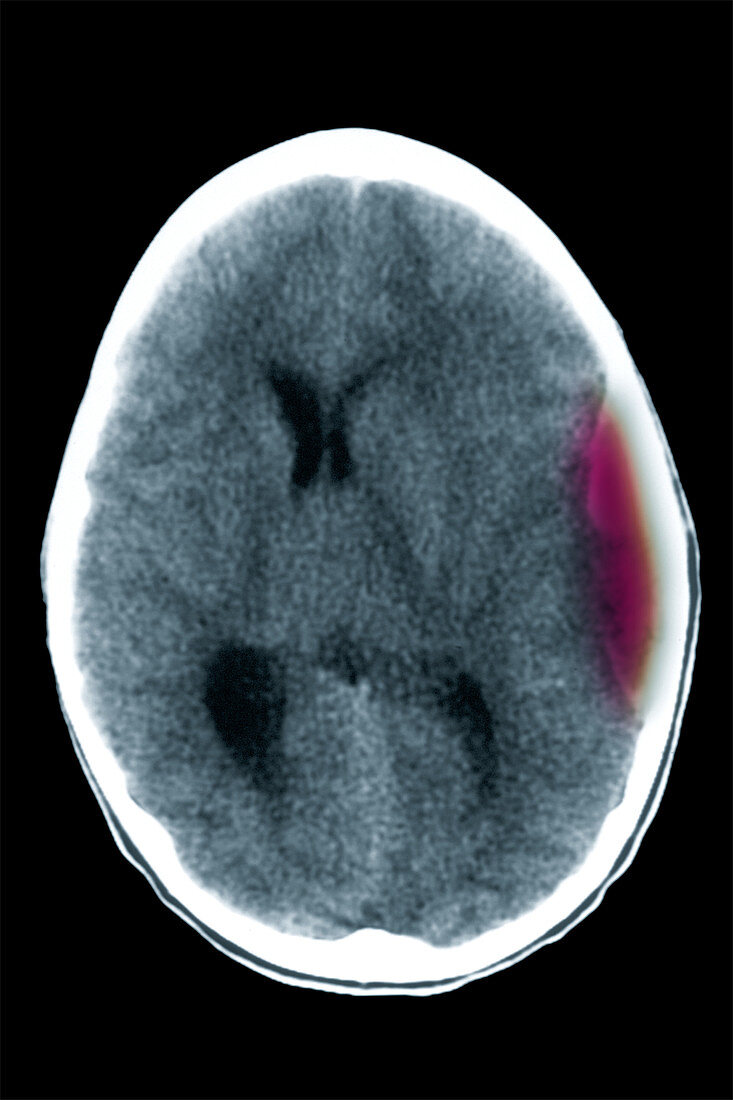 Cerebral CT showing subdural haematoma