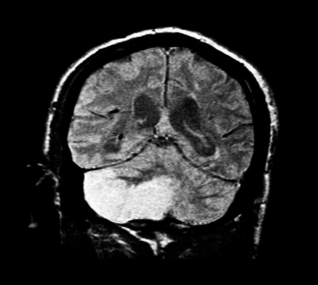 MRI of a Cerebellar Infarction