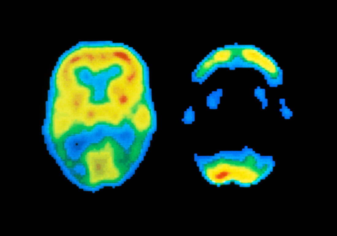 Brain images,one normal,one of dementia sufferer