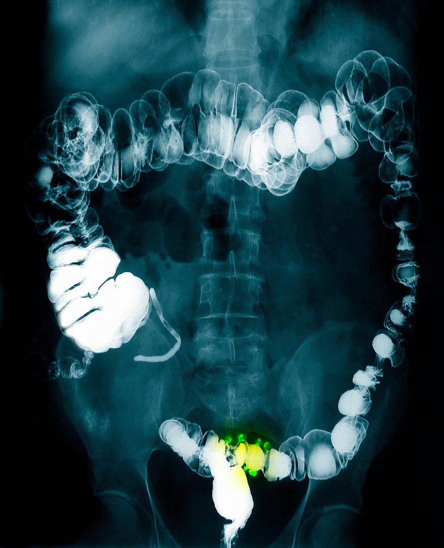 Colon diverticula,X-ray