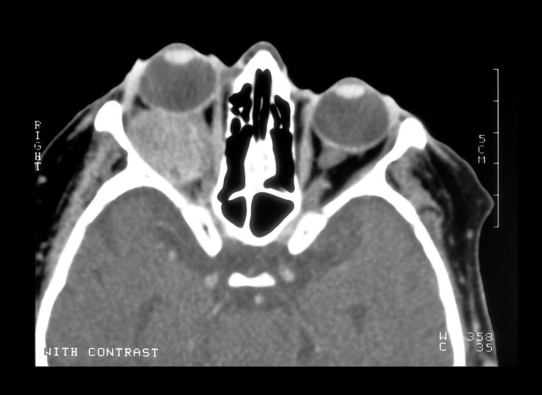 CT Scan of Orbital Mass