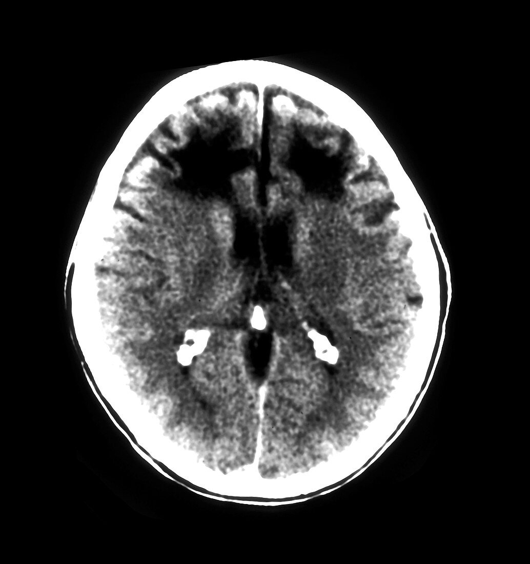 CT of Frontal Lobotomy