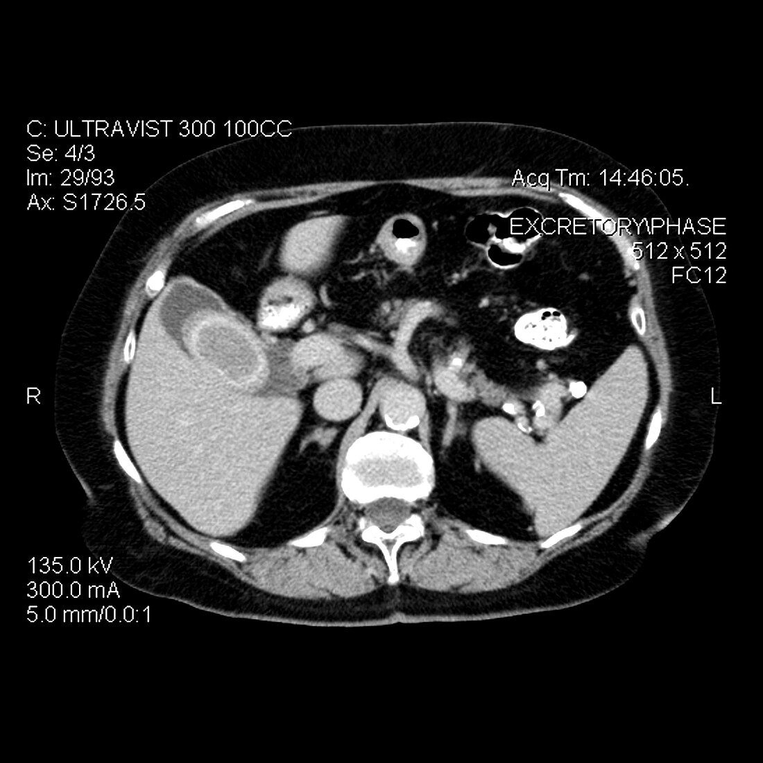 CT of Abdomen Shows Large Gallstone