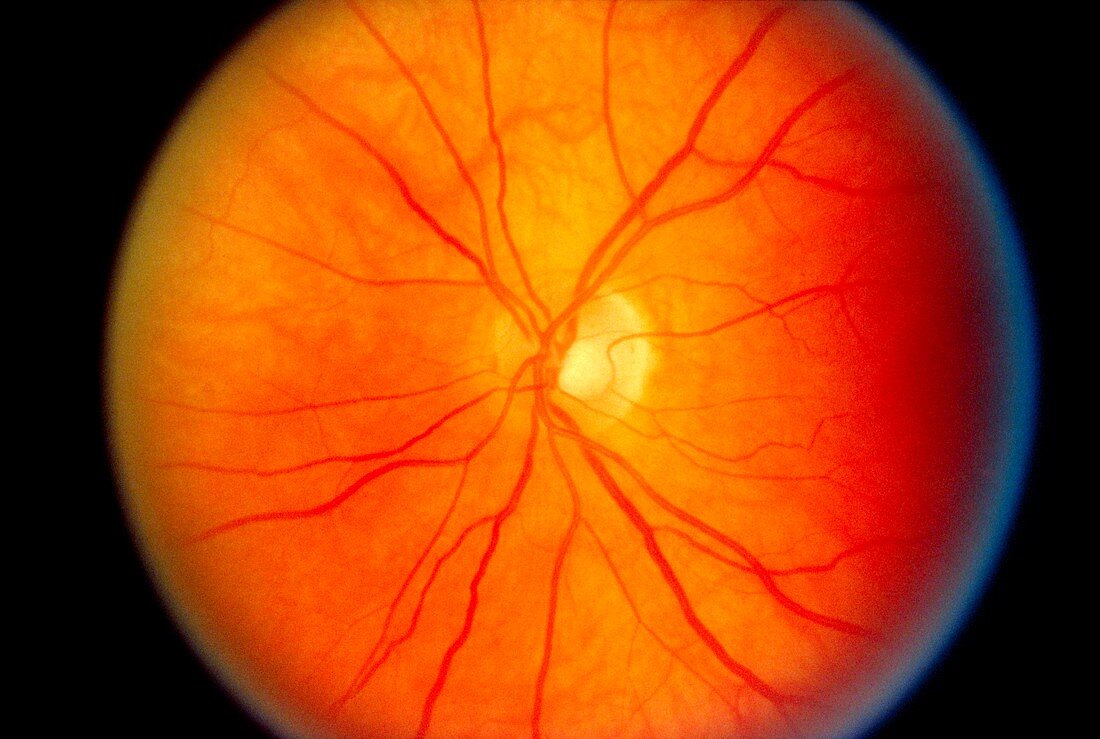 Ophthalmoscopy of eye in hypertension