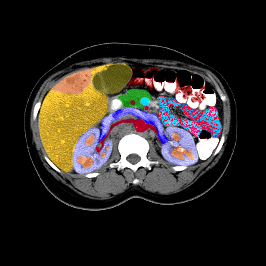 CT Cross Section of Liver Tumor