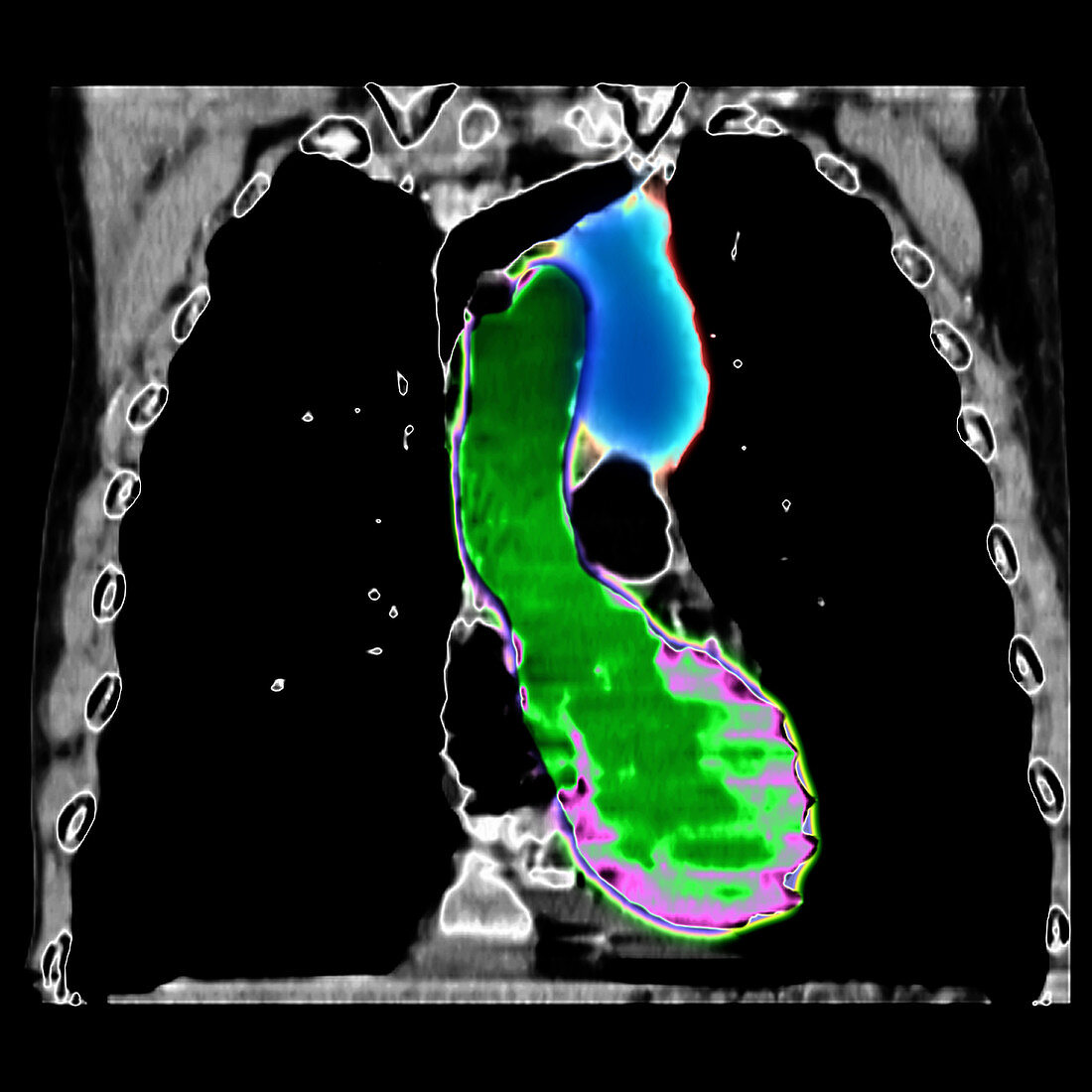 CT reconstruction of chest