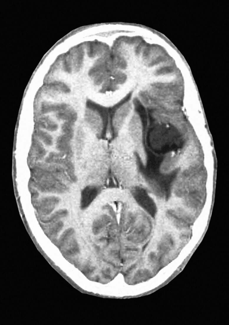 Glioma brain tumor