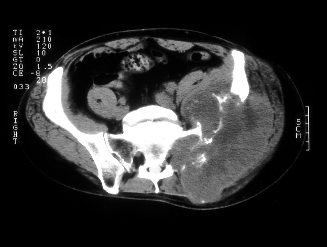 CT of Metastatic Renal Cell Carcinoma