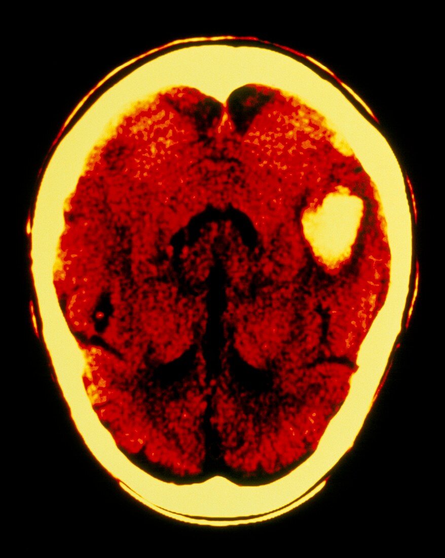 F/col CT scan of brain haemorrhage (post temporal)