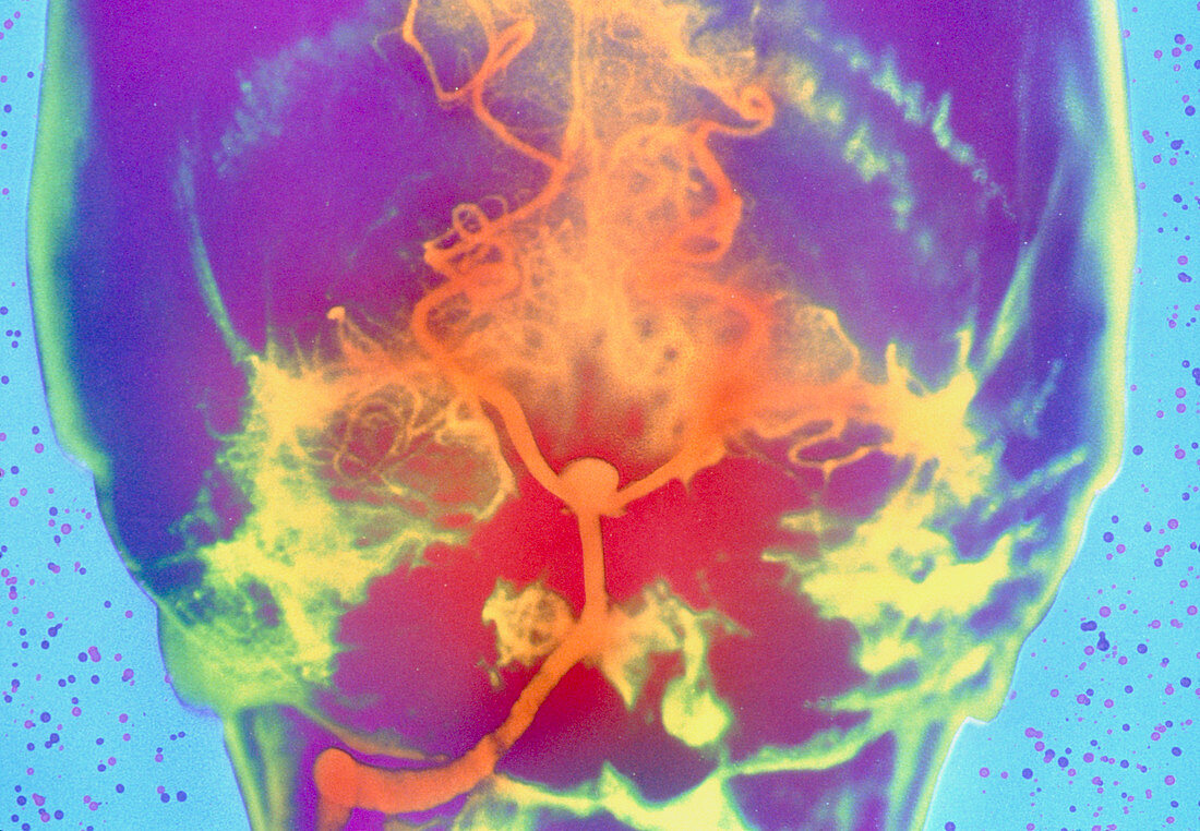 Coloured arteriogram of aneurysm in basilar artery