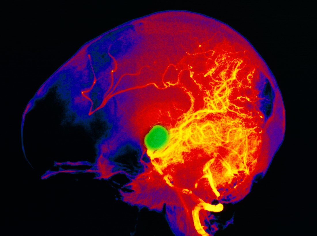 Coloured angiogram of cerebral aneurysm