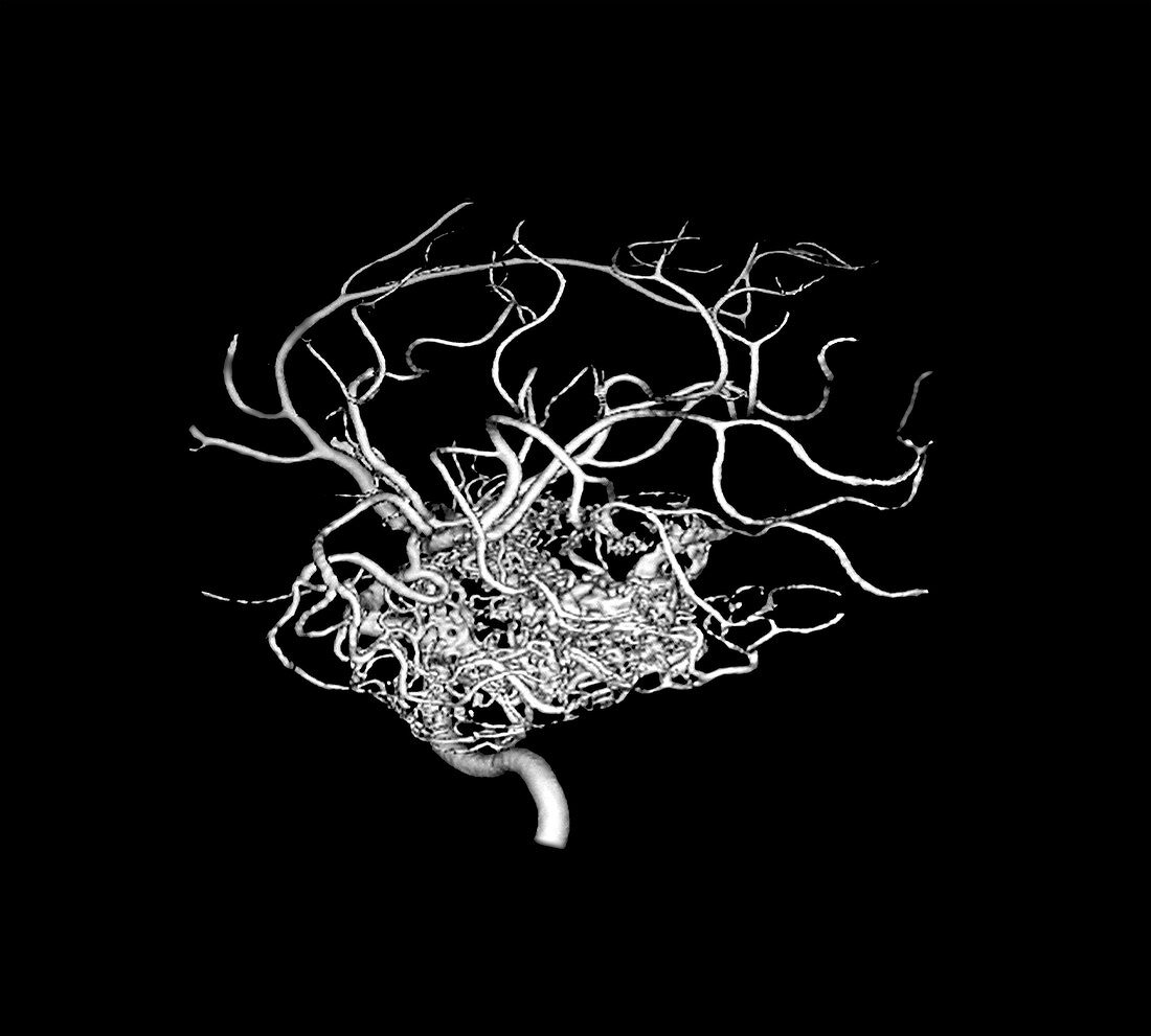 3D angiogram of temporal lobe AVM