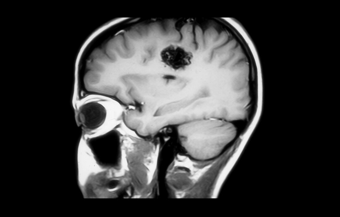 MRI of cerebral arterial venous malformation