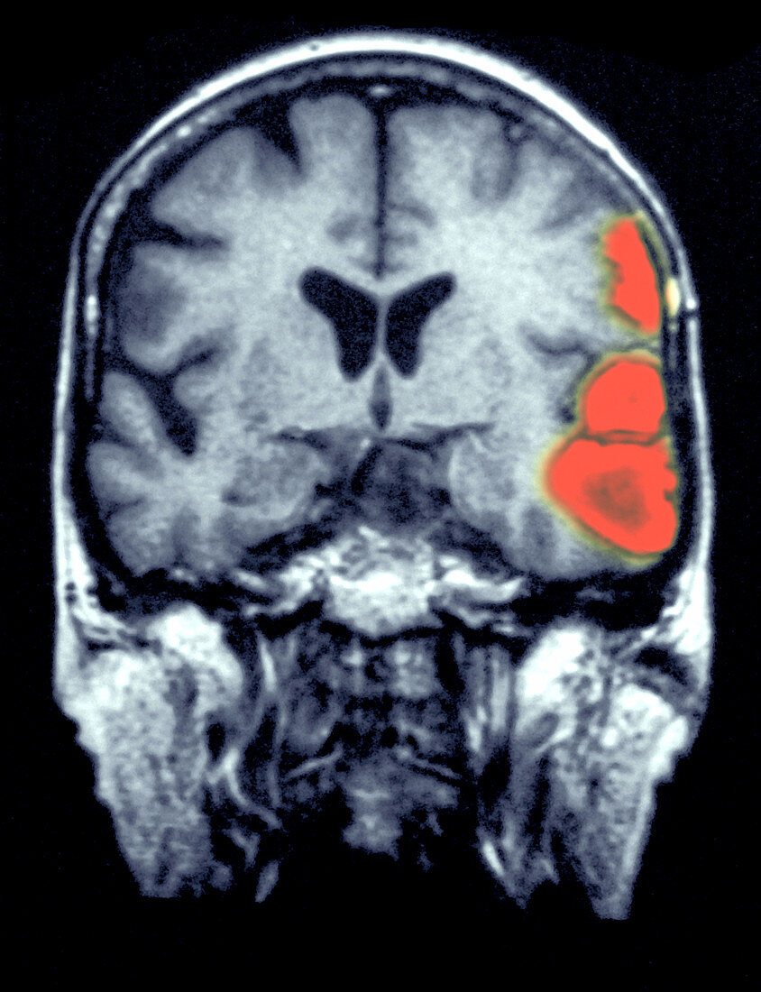 MRI Scan of a Brain Hemorrhage