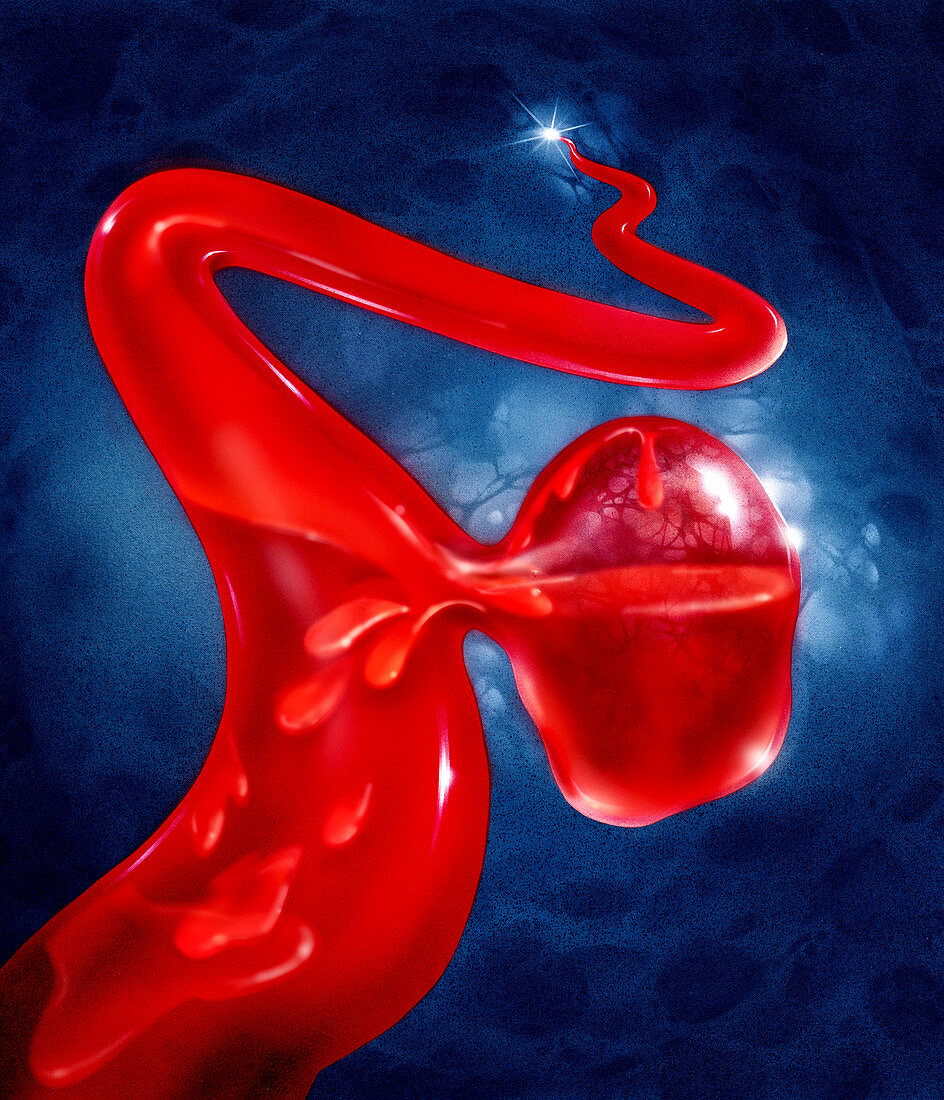 Illustration of an aneurysm