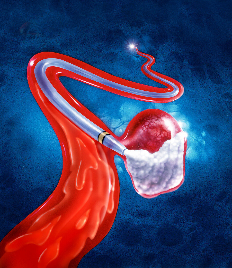 Illustration of aneurysm therapy