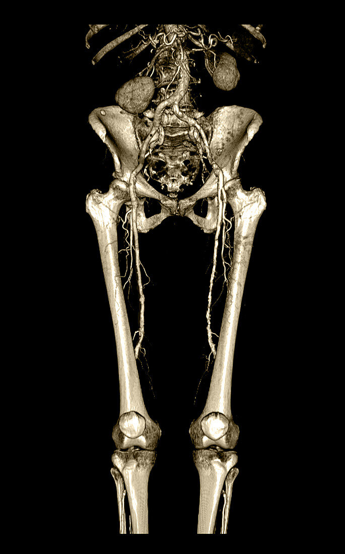 CT Angiogram of Pelvis and Legs