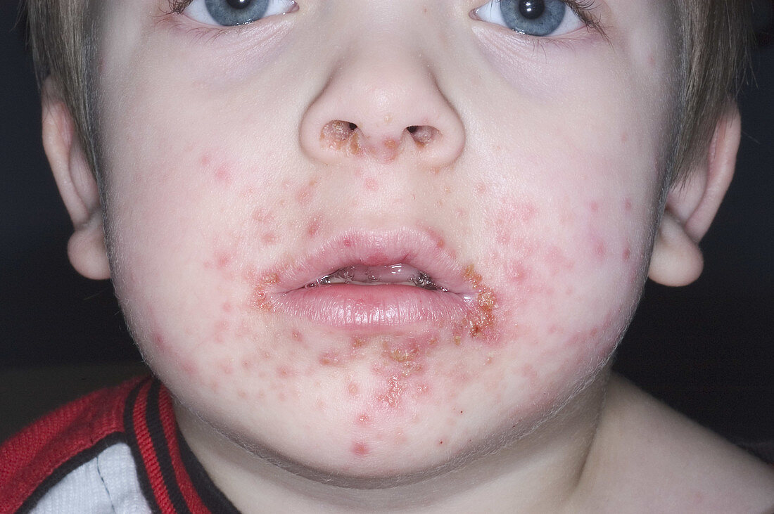 Impetigo