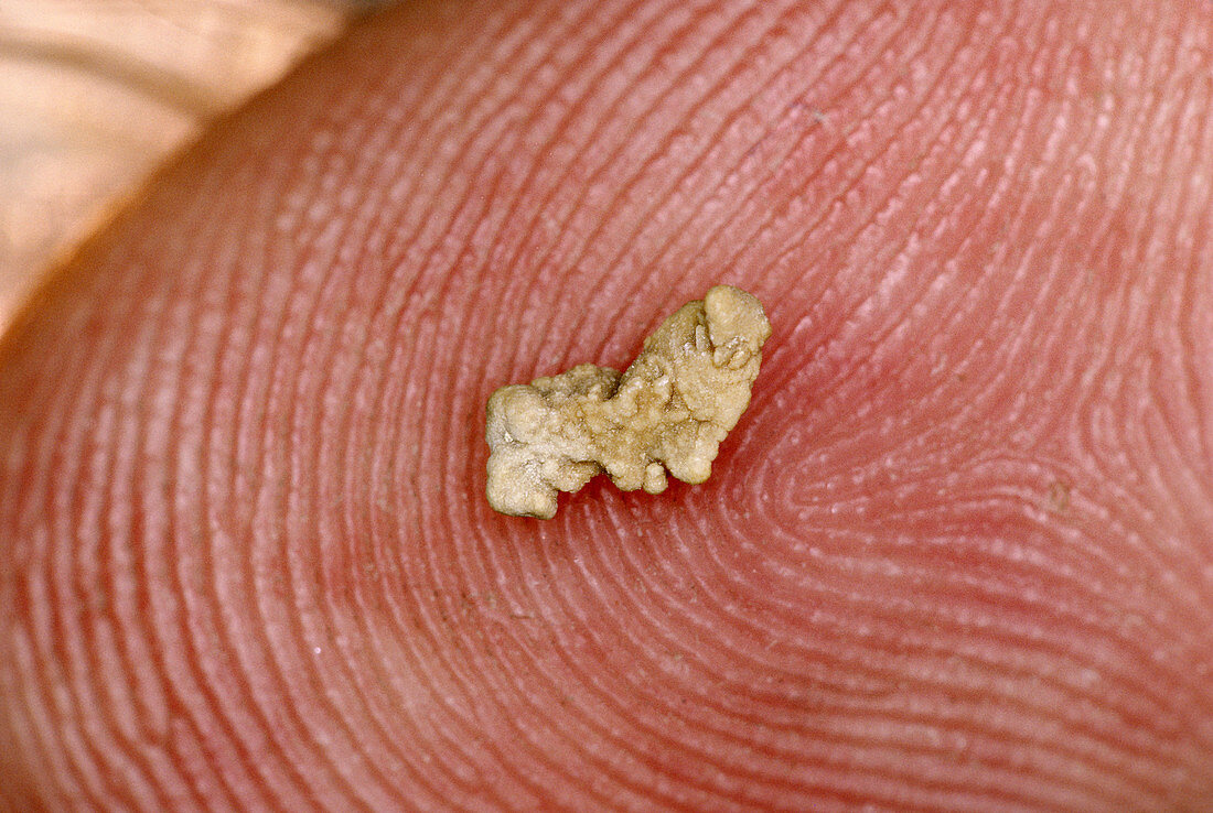 Kidney Stone