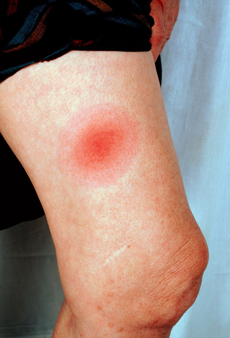 Erythema migrans rash on leg,Lyme Disease