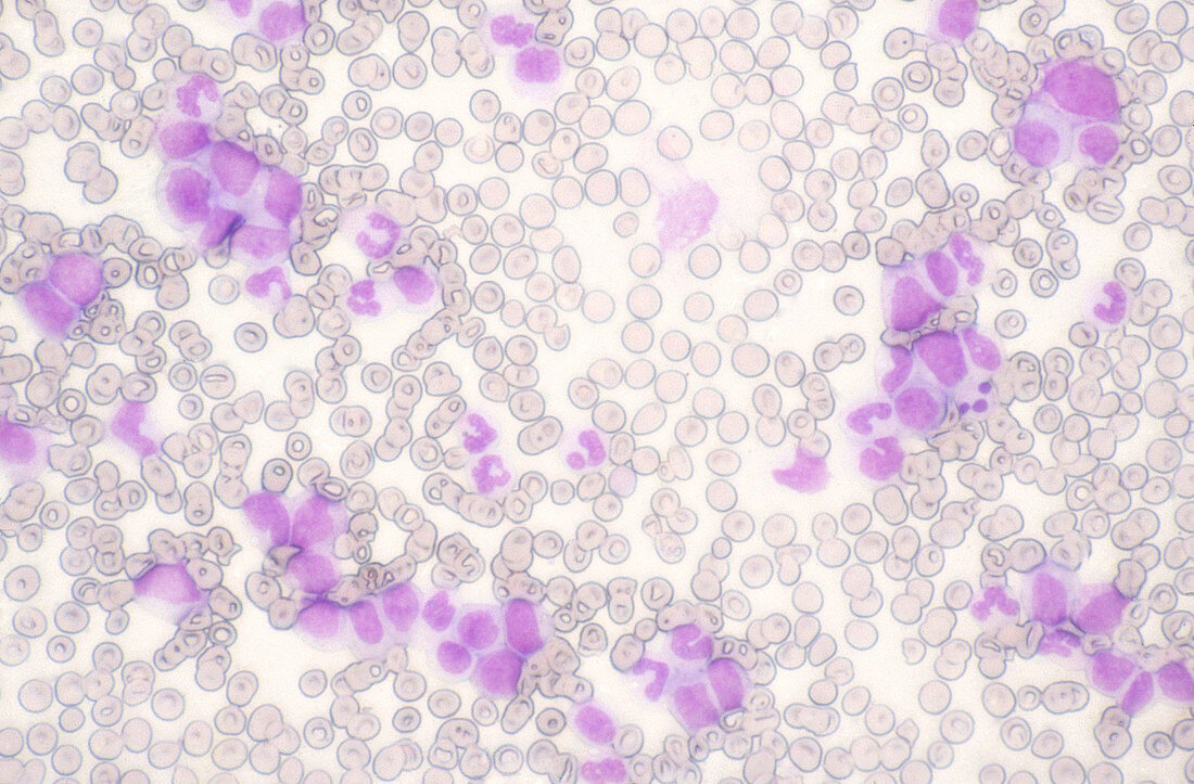 Leukemia