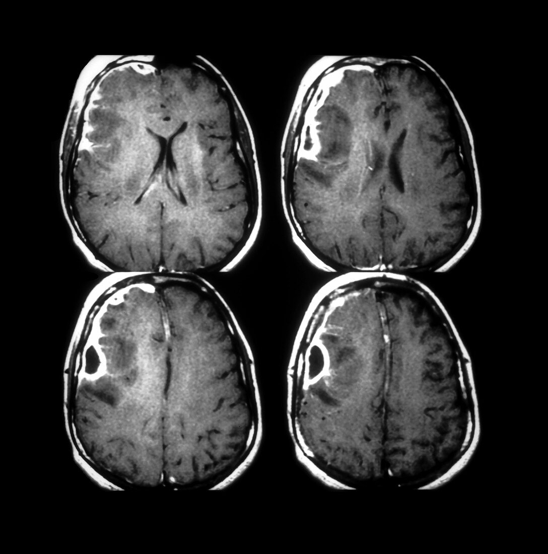 MRI of Cerebral Infection
