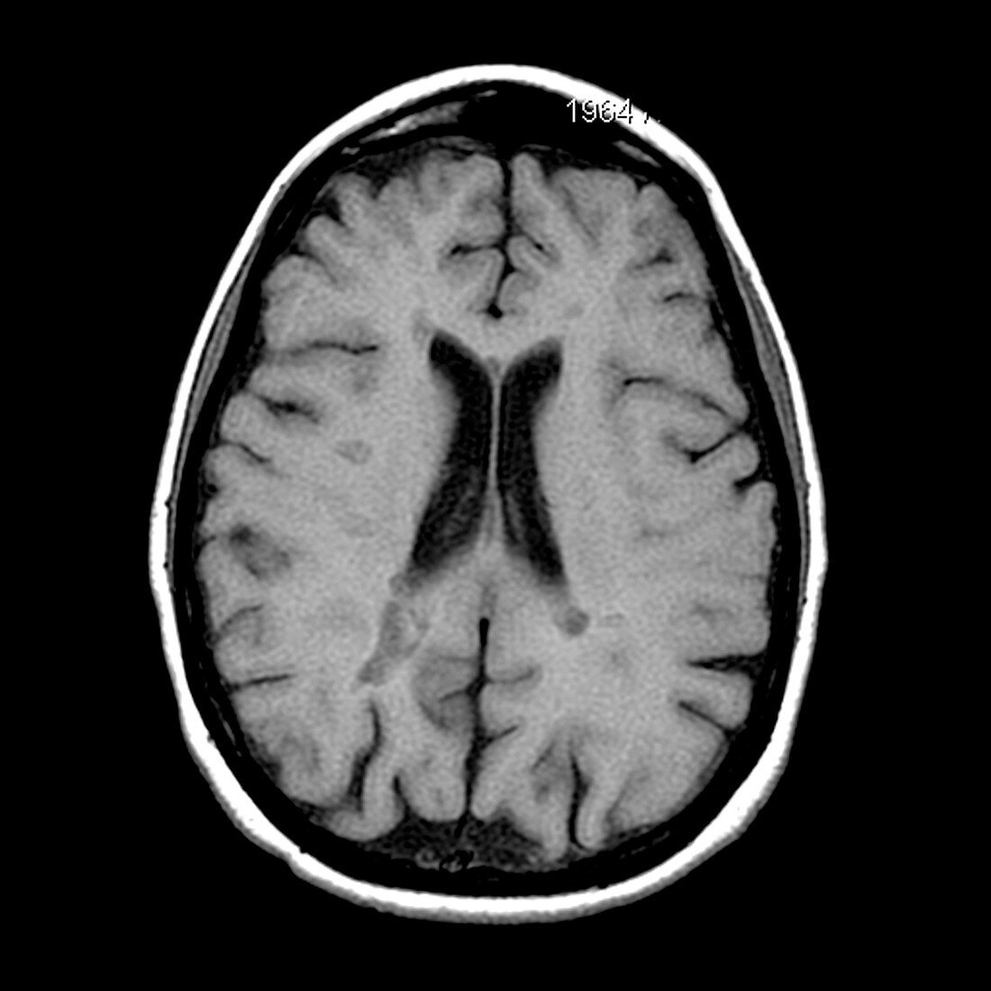 MRI of Multiple Sclerosis
