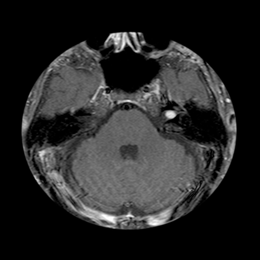 MRI of Acoustic Neuroma