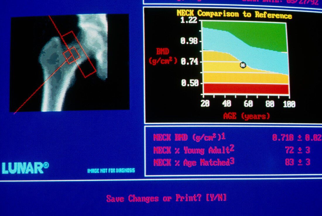 Bone density scan result in osteoporosis