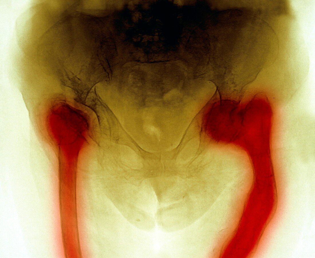Brittle bones,X-ray
