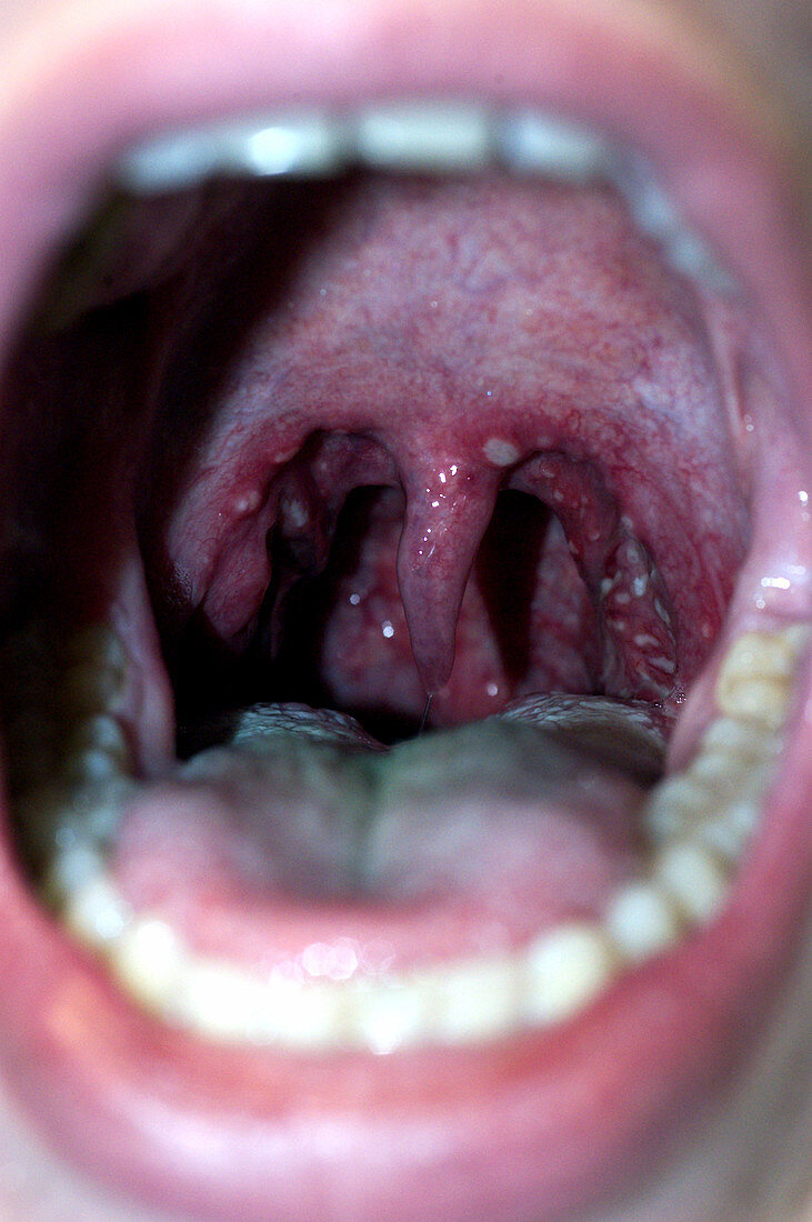 Severe Pharyngitis (Sore Throat)