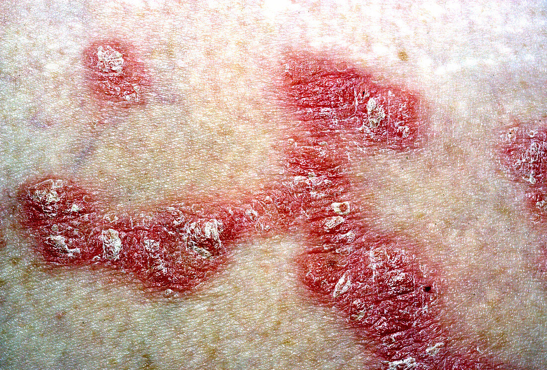 Psoriasis in a 43 Year Old Female