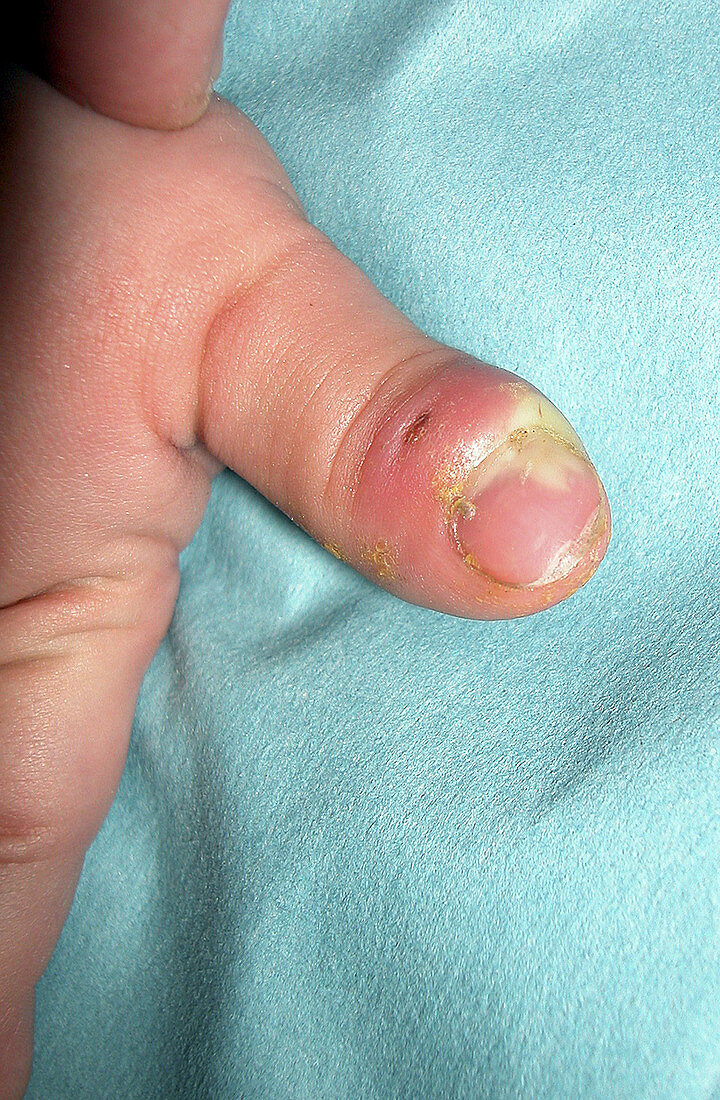 Paronychia infection from cat bite