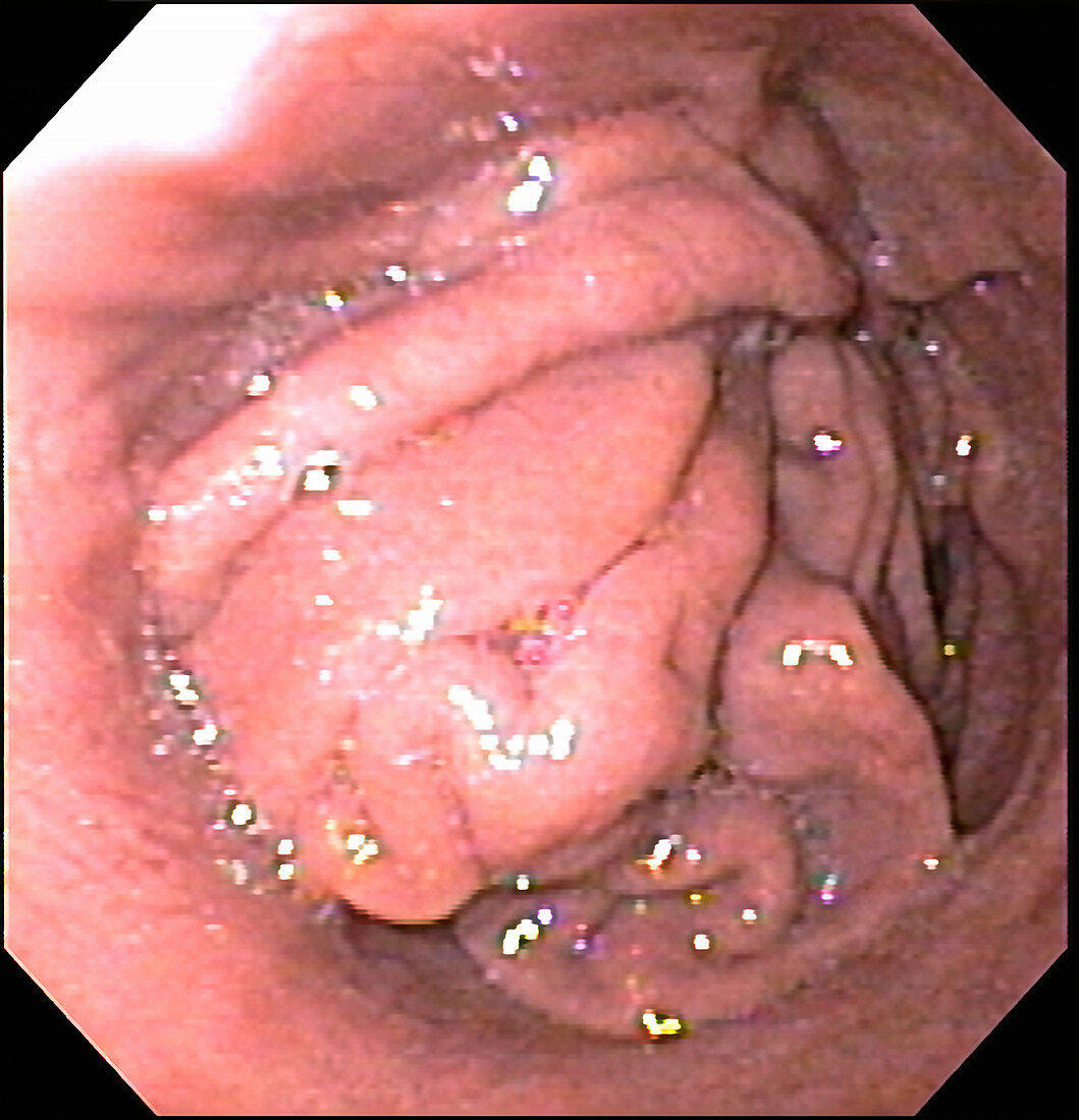 Hiatal Hernia