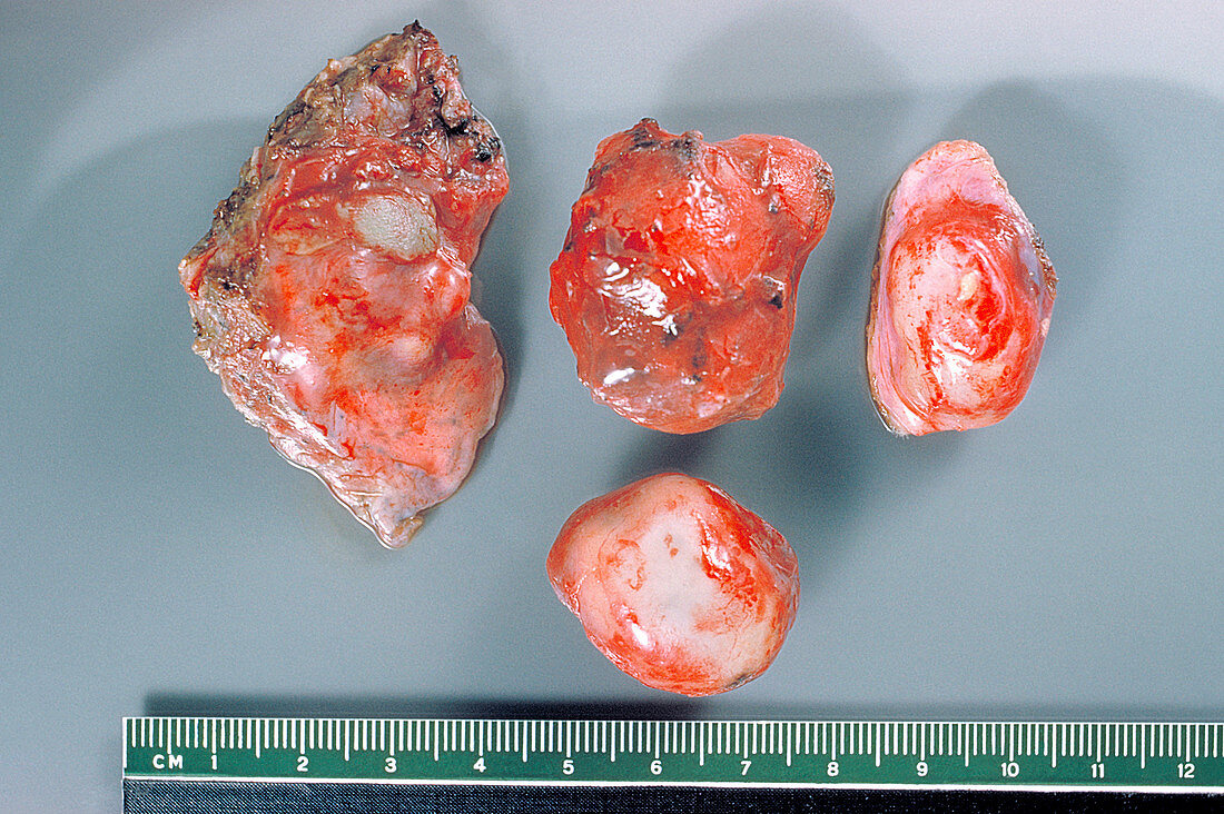 Hydatid Cysts From a Human Lung