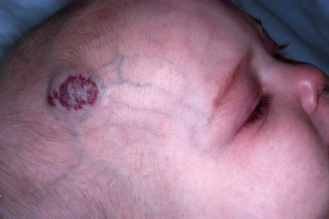 Hemangioma of the Scalp