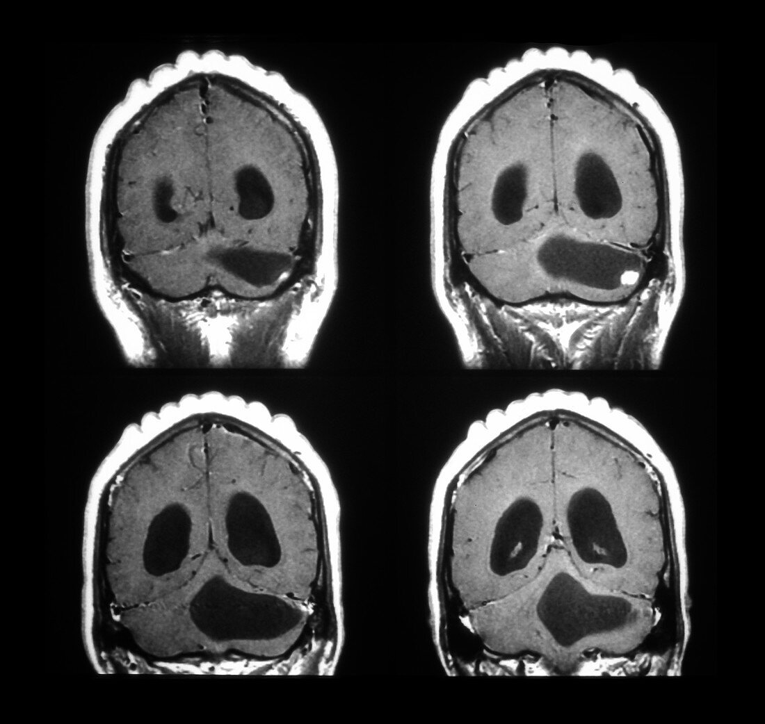 MRI of Cerebellar Hemangioblastoma