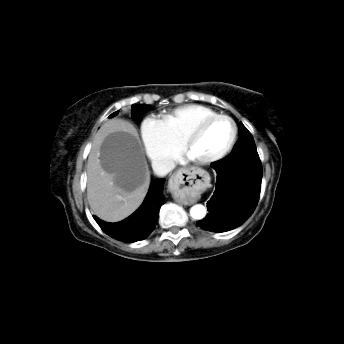 CT of Hiatal Hernia and Liver Cyst