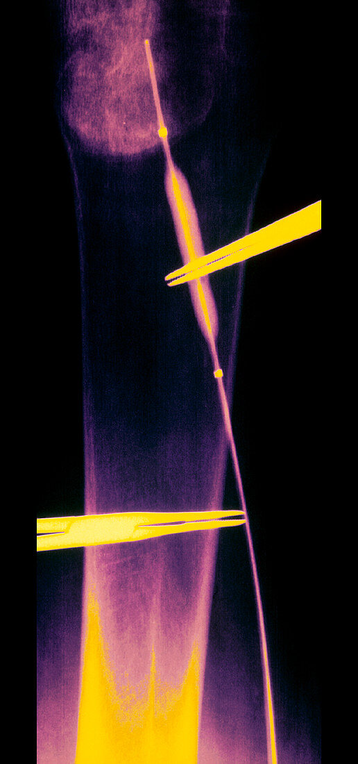 Coloured X-ray of balloon angioplasty in leg vein
