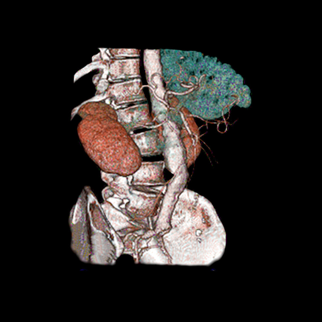 Abdominal aortic aneurysm and kidney