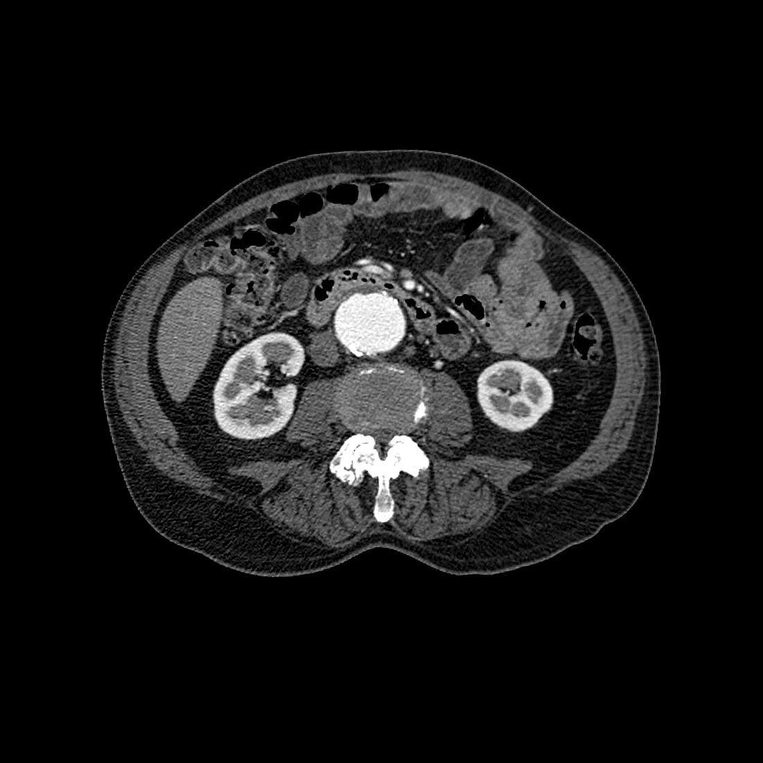 CT mid abdominal region