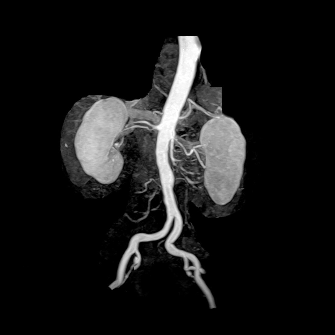 Abdominal Aorta and Kidneys
