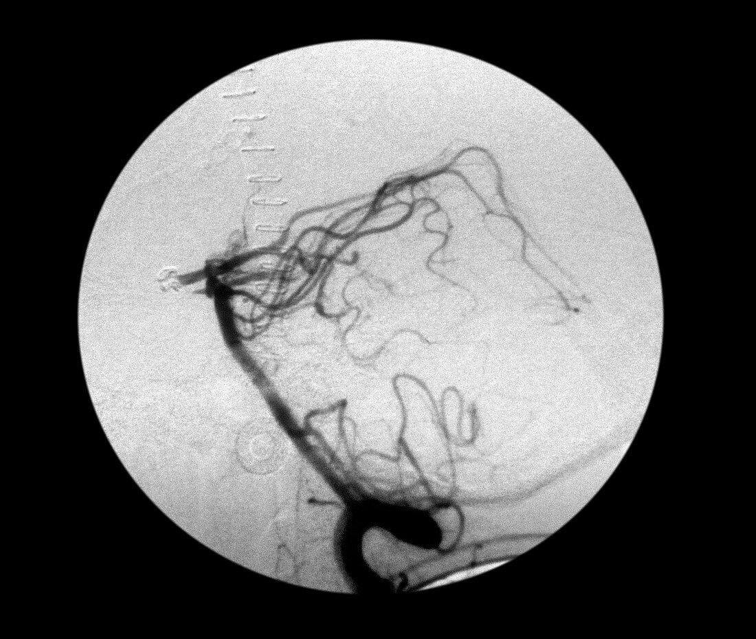 Angiogram of the Basilar Artery