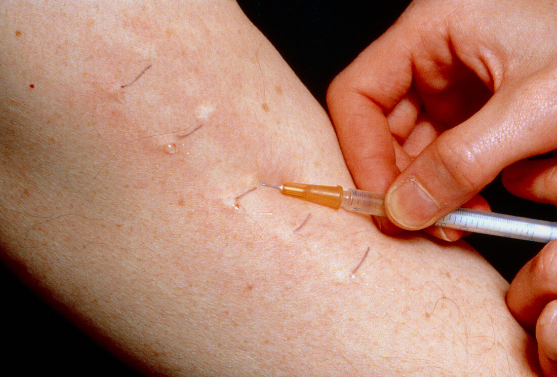Allergy testing: subcutaneous injection down arm