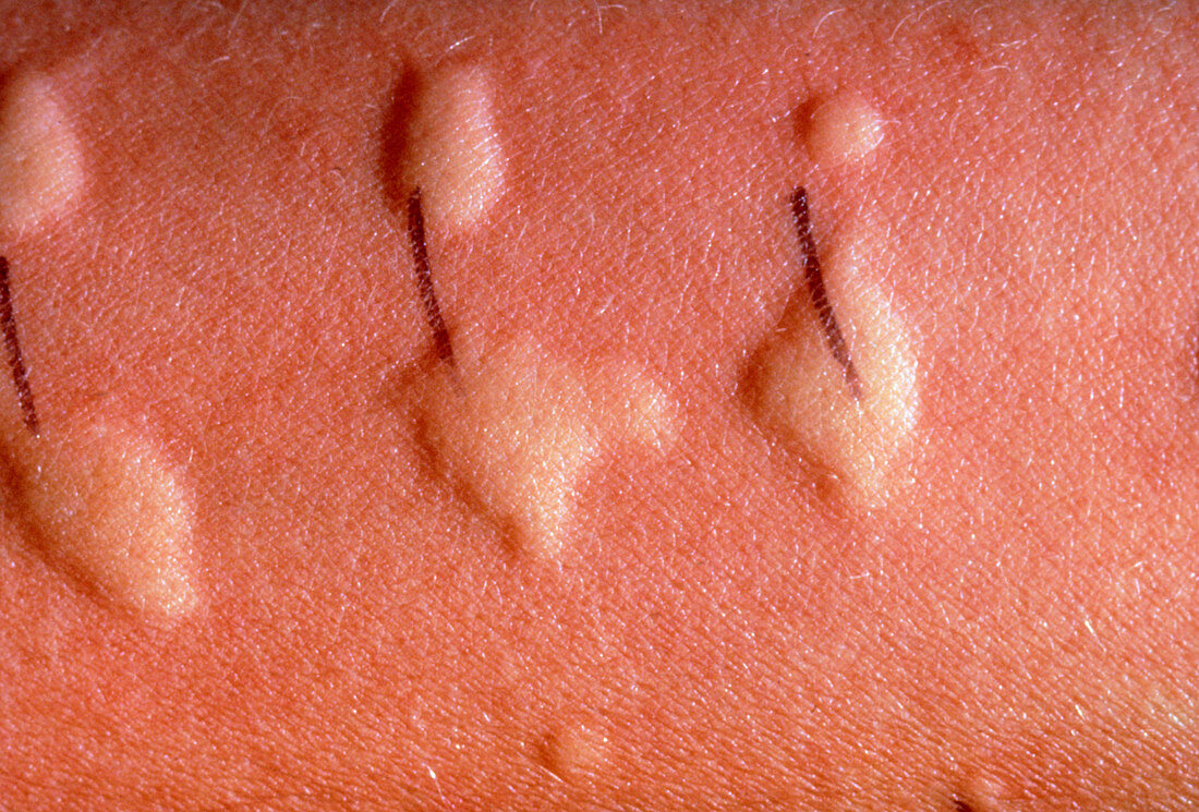 Allergy test on skin