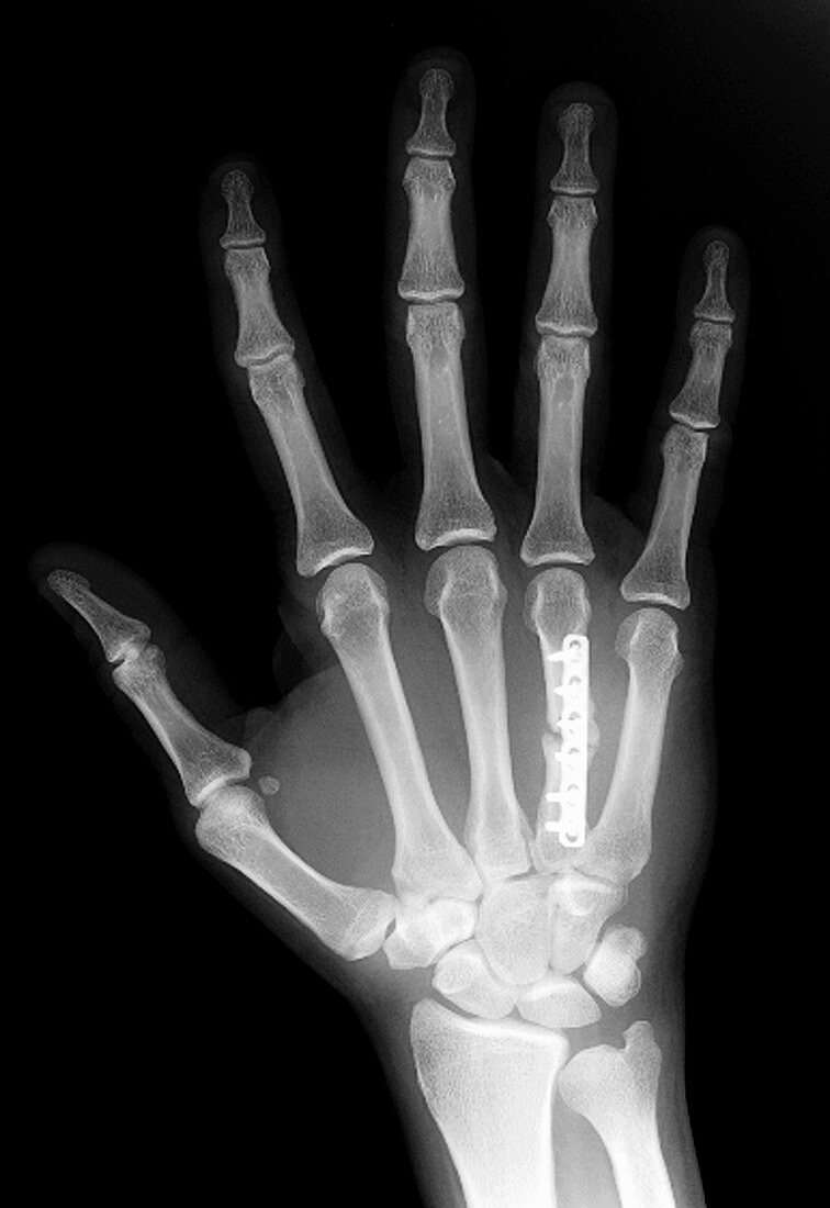 Finger Fracture