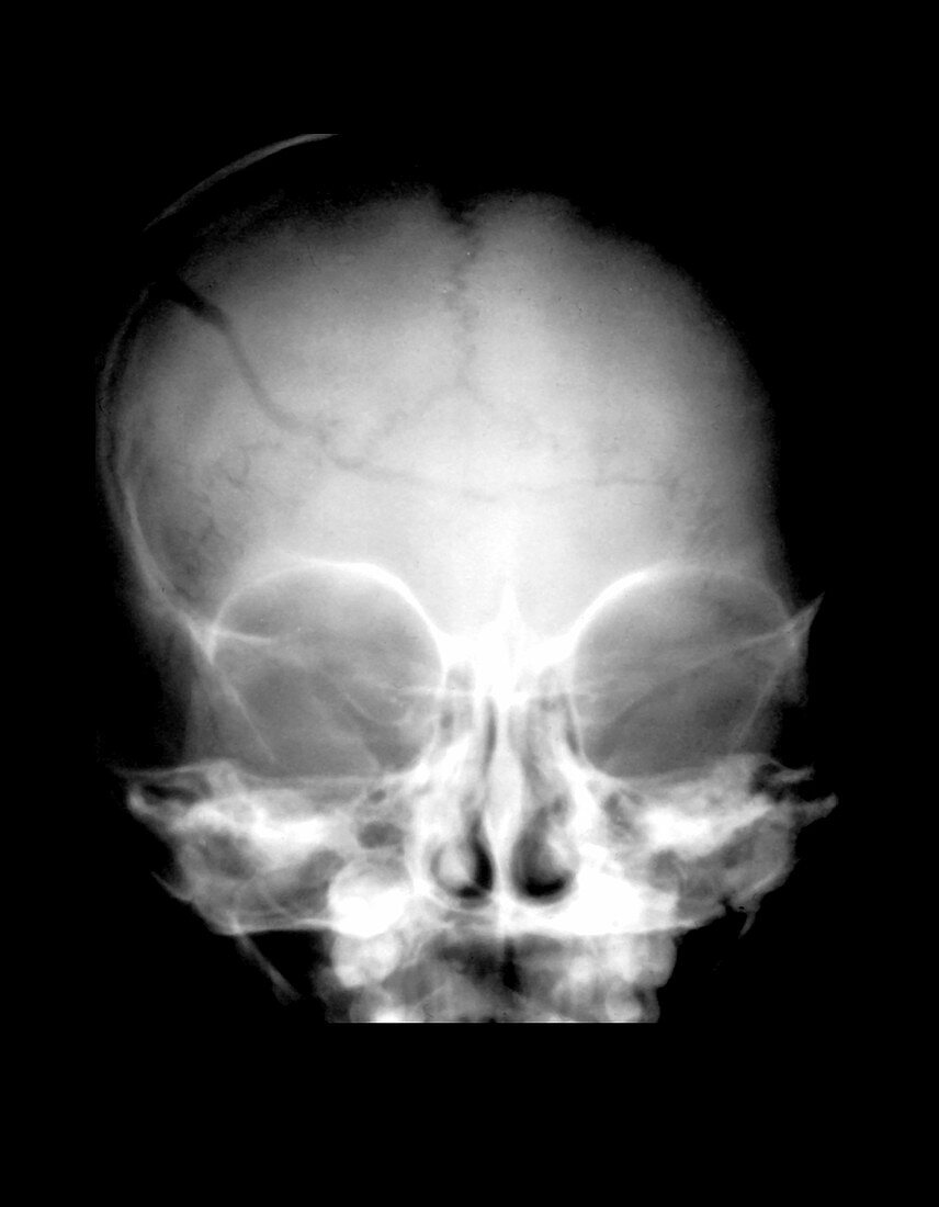Lateral X-Ray of a Child With Head Trauma