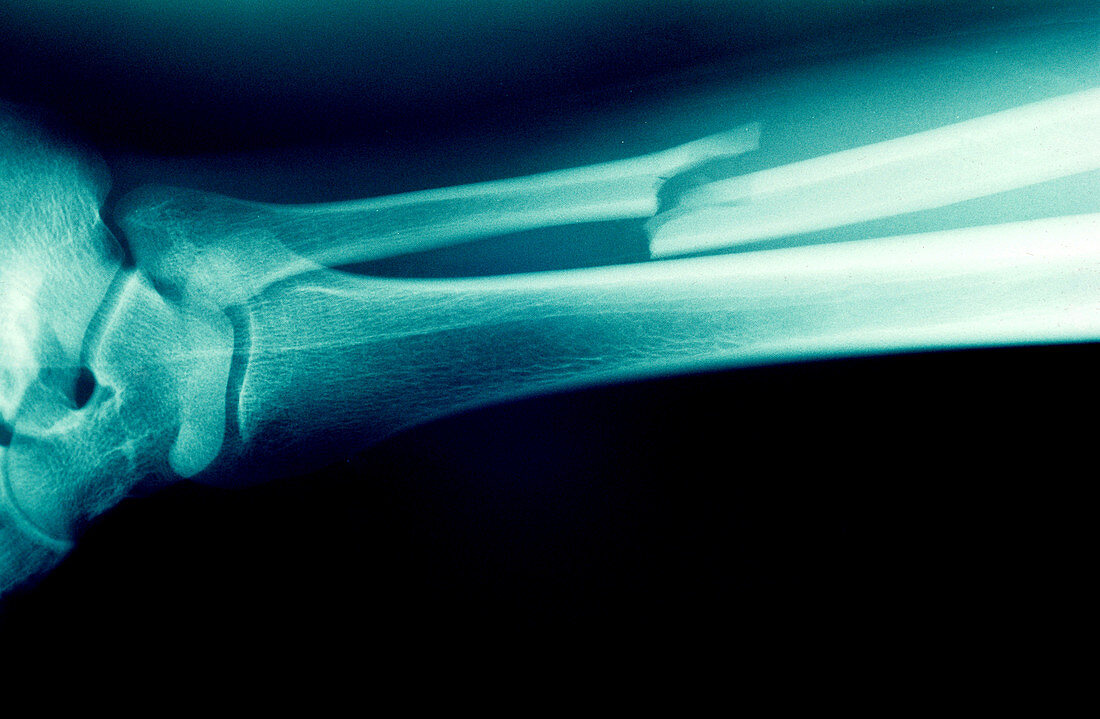 X-ray of Fibula fracture