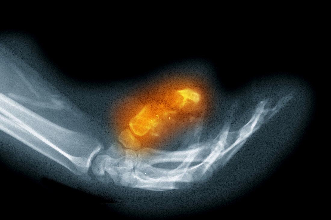 X-Ray of a Gunshot Wound to the Hand