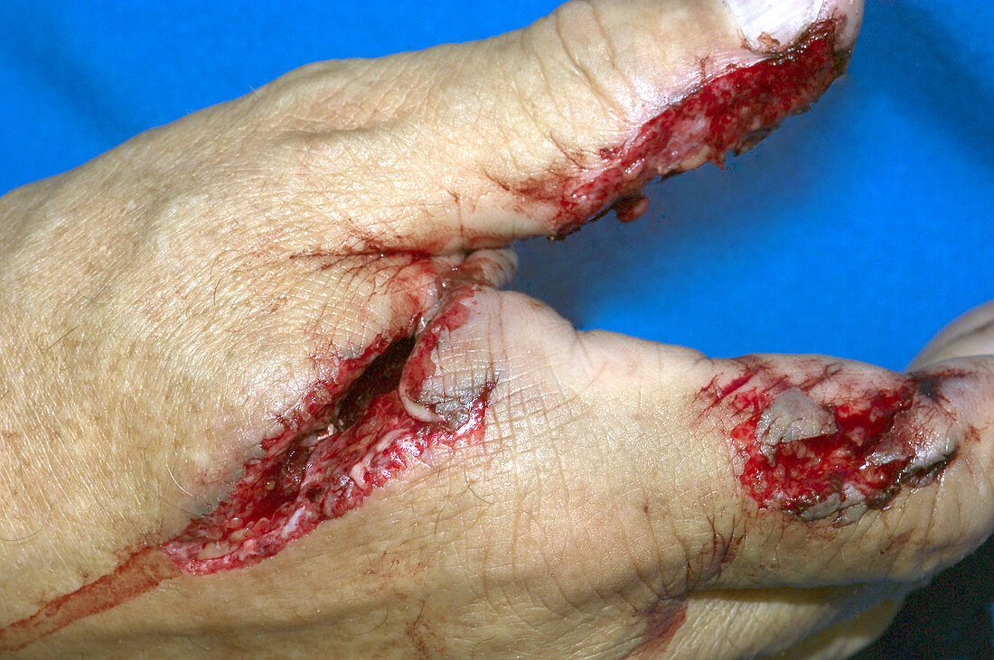 Hand Laceration